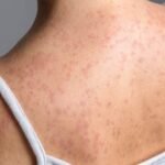 PRI Nuevo León responsabiliza a Morena por el regreso del sarampión en México